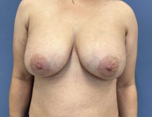 image before breast implant removal and mastopexy with fat transfer- front view case 5523