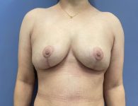 image after breast implant removal and mastopexy with fat transfer- front view case 5523