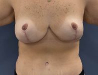 image after breast implant removal - front view case 6434