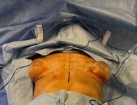 Operation Image of Breast Revision with Capsulectomy Case 4910