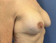 After Image of Breast Revision with Capsulectomy Right Side 45 degree View Case 4910