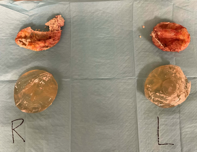 Implant Image Left and Right Case 4910