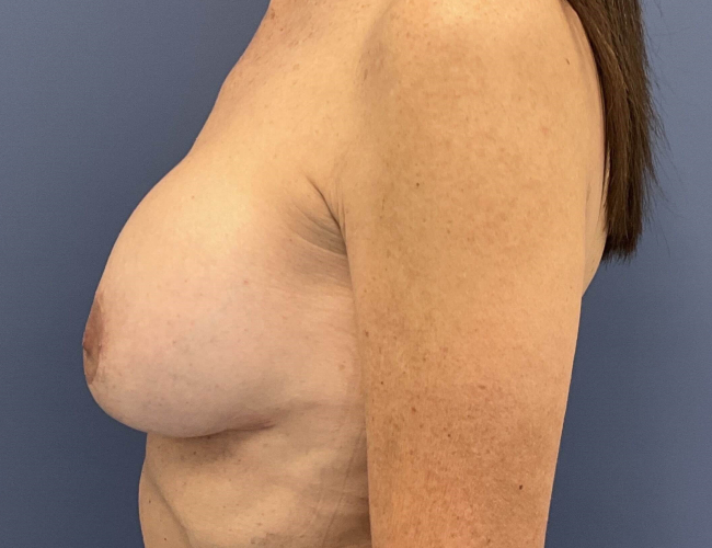 After Image of Breast Revision with Capsulectomy Left Side View Case 4910