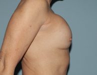 before breast revision - ruptured implant right angle case 4938