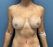 after breast revision - ruptured implant front view case 4938