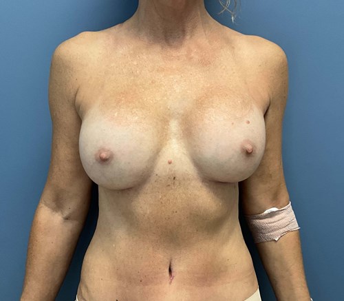 after breast revision - ruptured implant front view case 4938