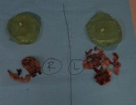 multiple ruptured implants case 4938