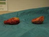 severe capsular contracture implant removed case 7400