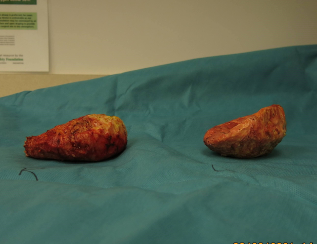 severe capsular contracture implant removed case 7400