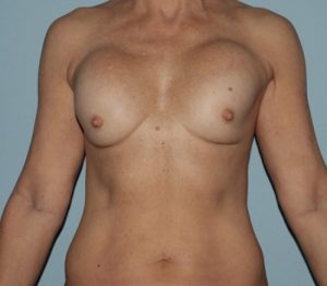 before breast revision - ruptured implant front view case 4938