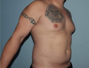 image before gynecomastia with vaser liposuction - male patient 45 degrees right angle case 6871