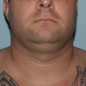 Before Image of Submental Liposuction Improves Jawline Men Front Side View Case 6960