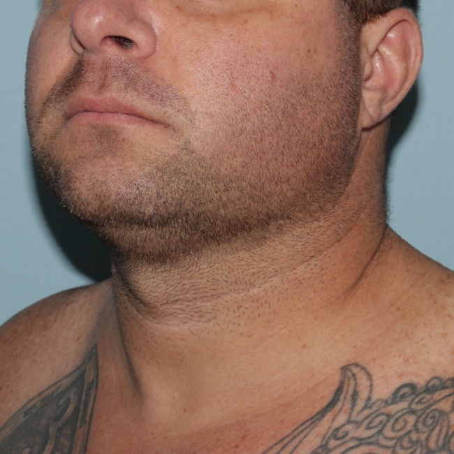 After Image of Submental Liposuction Improves Jawline Men Left Side 45 degree View Case 6960