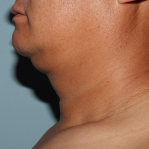 Before Image of Liposuction Improve Double Chin- Men Left Side View Case 6975