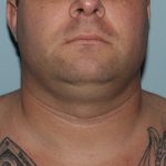 Before Image of Submental Liposuction Improves Jawline Men Front Side View Case 6960