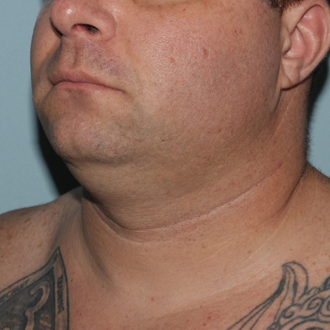 Before Image of Submental Liposuction Improves Jawline Men Left Side 45 degree View Case 6960