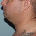 Before Image of Submental Liposuction Improves Jawline Men Left Side View Case 6960