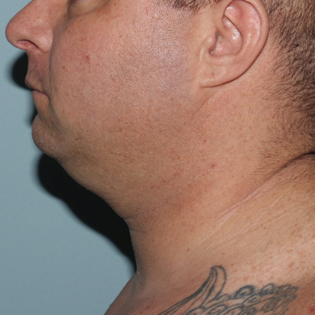 Before Image of Submental Liposuction Improves Jawline Men Left Side View Case 6960