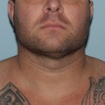 After Image of Submental Liposuction Improves Jawline Men Front Side View Case 6960