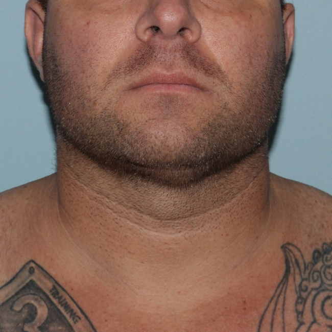 After Image of Submental Liposuction Improves Jawline Men Front Side View Case 6960