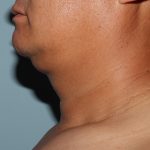 Before Image of Liposuction Improve Double Chin- Men Left Side View Case 6975