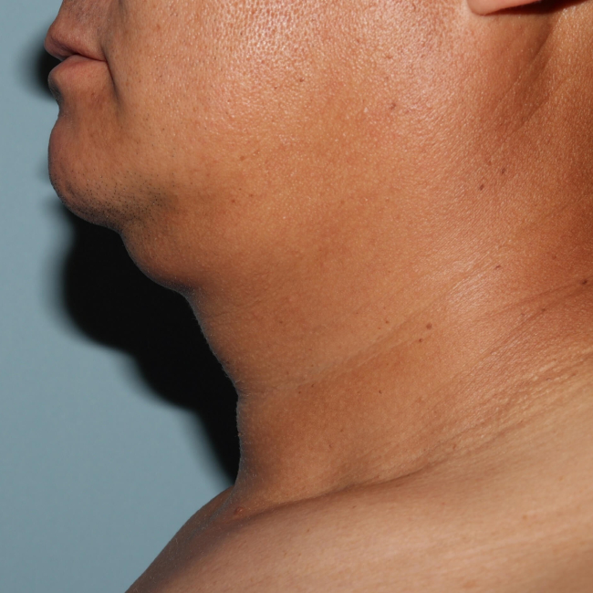 Before Image of Liposuction Improve Double Chin- Men Left Side View Case 6975