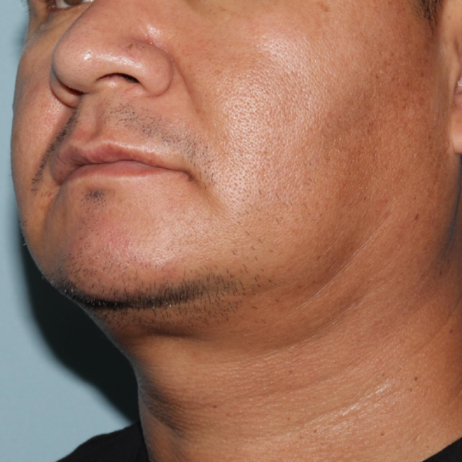 Before Image of Liposuction Improve Double Chin- Men Left Side 45 degree View Case 6975