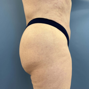 After Image of Lower Body Lift, Buttock Lift or Gluteal Lift Right Side view P-7634
