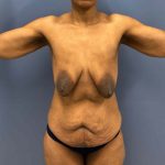 before lower body lift female patient front view case 7631