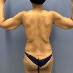 before lower body lift female patient back view case 7631