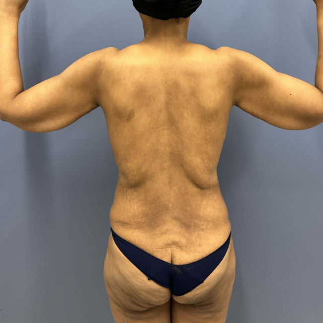 before lower body lift female patient back view case 7631