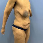 before lower body lift female patient right angle view case 7631