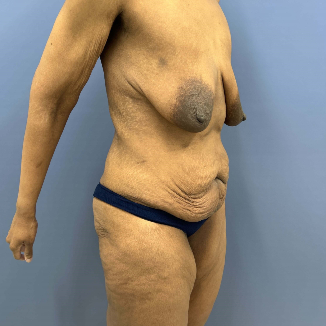before lower body lift female patient right angle view case 7631