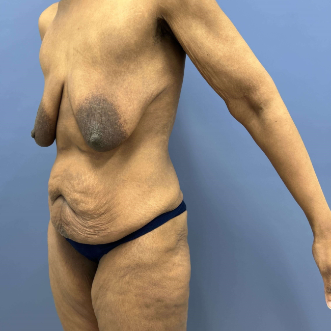 before lower body lift female patient left angle view case 7631