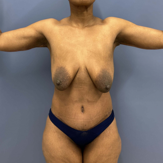 after lower body lift female patient front view case 7631