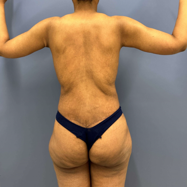 after lower body lift female patient back view case 7631