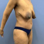 after lower body lift female patient right angle view case 7631