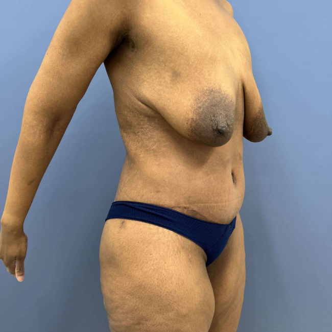 after lower body lift female patient right angle view case 7631