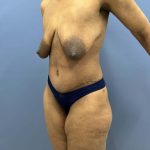 after lower body lift female patient left angle view case 7631