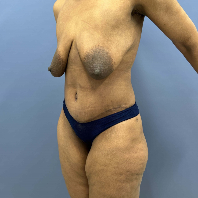 after lower body lift female patient left angle view case 7631