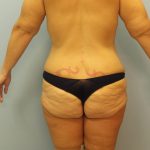 before lower body lift female patient back view case 7630