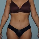 after lower body lift female patient front view case 7630