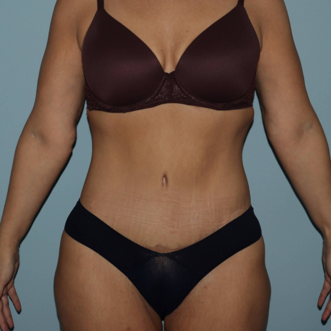 after lower body lift female patient front view case 7630