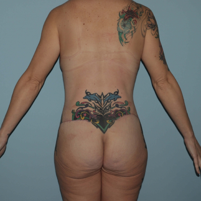 after lower body lift female patient back view case 7599