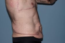 before lower body lift male patient right side view case 7584