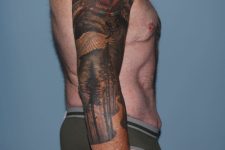 after lower body lift male patient right side view case 7584