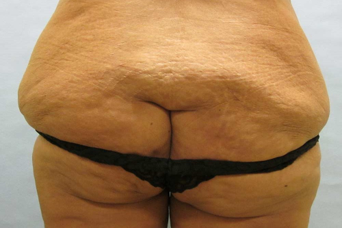 before lower body lift female patient back view case 7562