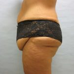 before lower body lift female patient side view case 7562