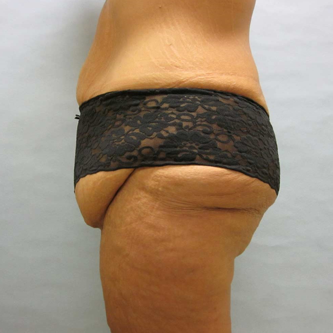 before lower body lift female patient side view case 7562