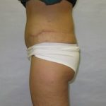 after lower body lift female patient side view case 7562